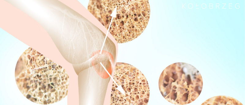 aktualność: Profilaktyka i wczesne wykrywanie osteoporozy” z KKM